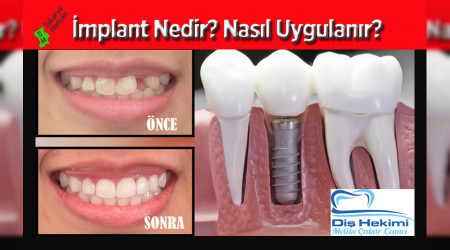 MPLANT NEDR? NASIL UYGULANIR?